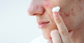 acne-treatments