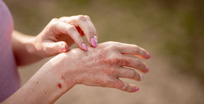 5 Summer Skincare Mistakes That Can Trigger Eczema