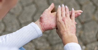 5 eczema triggers to watch for as autumn starts