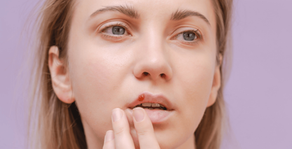 Cold sore stages: what to expect and how to treat each one