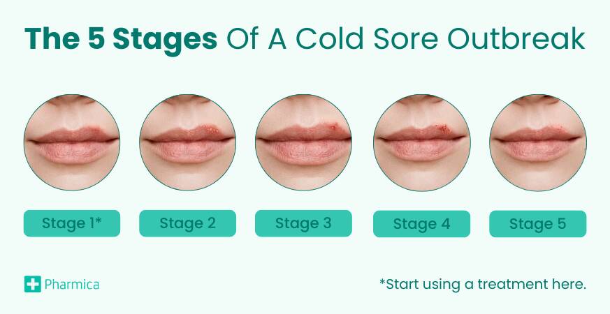 new research on cold sores